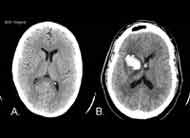 acidente_vascular_cerebral