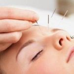 acupuntura estetica