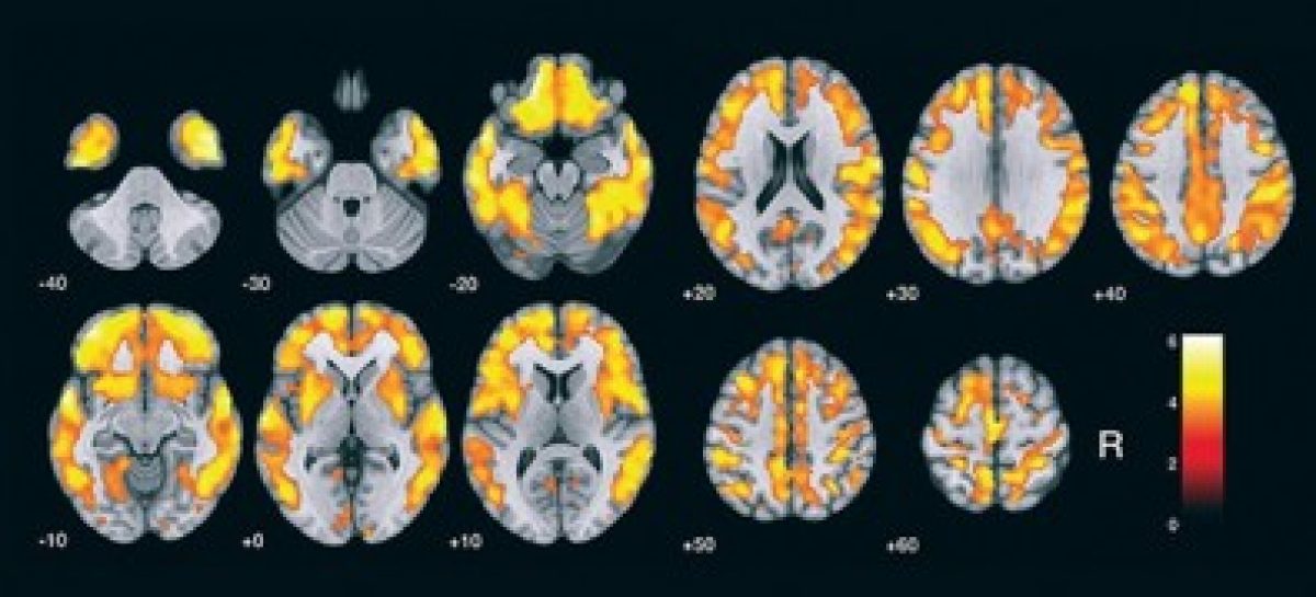 Método para detectar acúmulo de peptídeo ligado ao Alzheimer é validado no Brasil